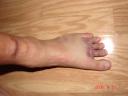 Ankle Img1